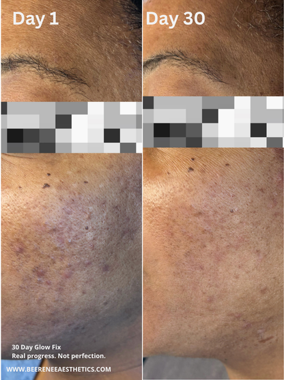 Before and after comparison of skin treatment on Day 1 and Day 30, showing visible improvement.